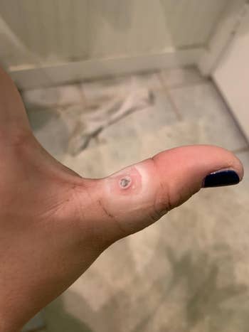 reviewer with a wart on their thumb
