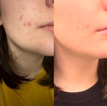Before-and-after comparison of a person's cheek showing improvement in skin clarity