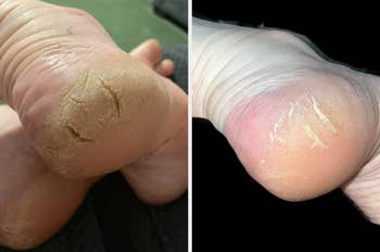 Close-up of 2 heels broadside by side, showing earlier and aft attraction for cracked skin
