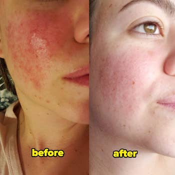 Reviewer with inflamed rosacea flare labeled before, and after with clear, calm skin