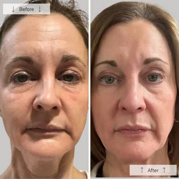 Split-screen comparing a woman's face before and after a skincare treatment