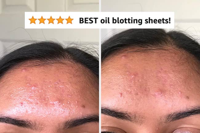 Two side-by-side images of a woman's forehead, showing earlier  and aft  effects of utilizing lipid  blotting sheets connected  acne-prone skin. 