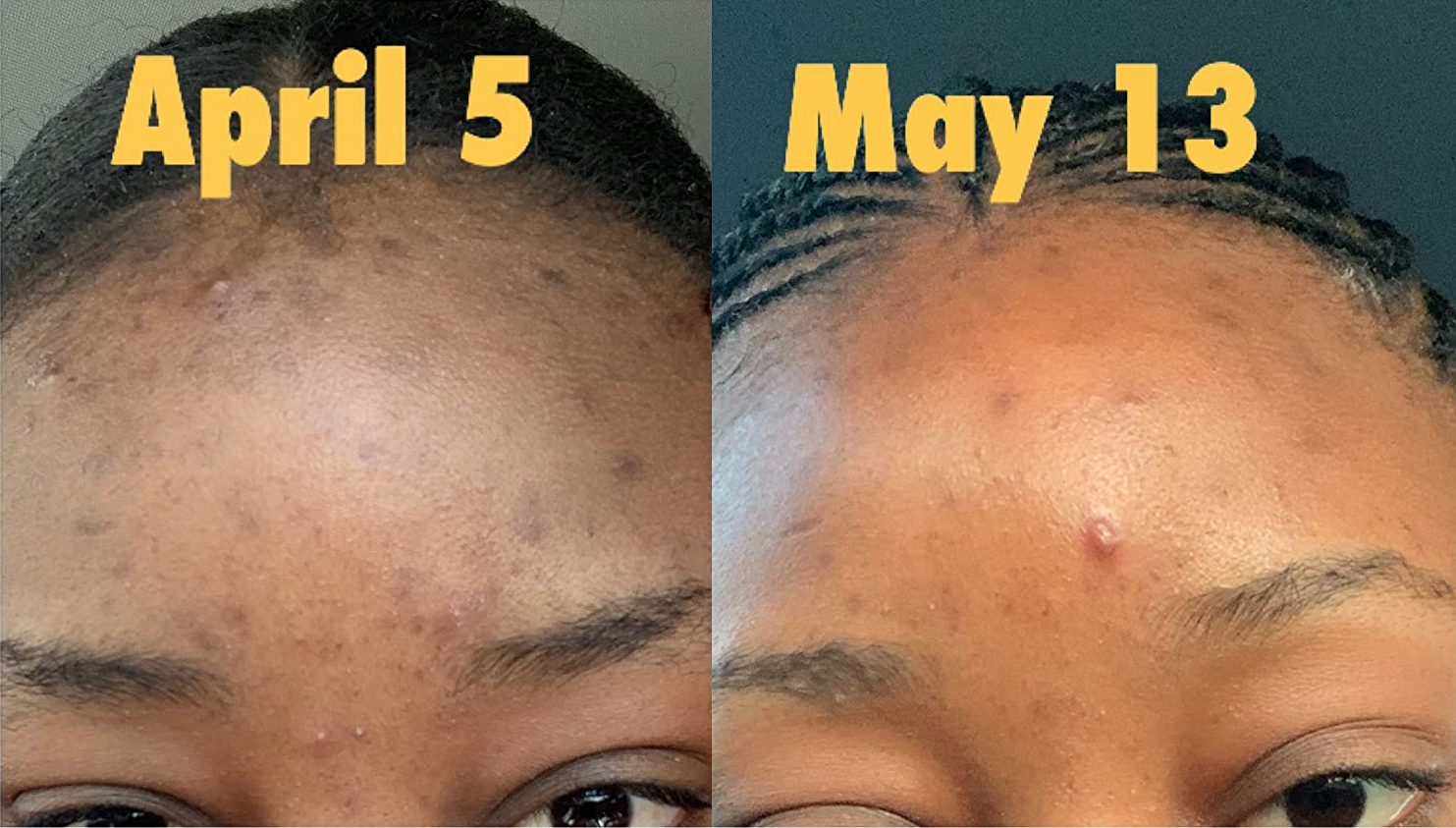 on the left, a reviewer forehead dotted with blackhead labeled 