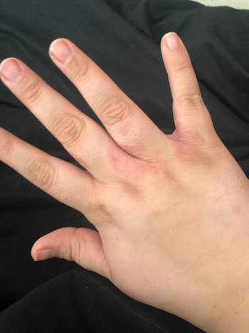 after reviewer image of the same hand now with no eczema present