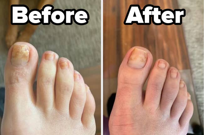 A reviewer earlier and aft utilizing the multipurpose nail repair solution