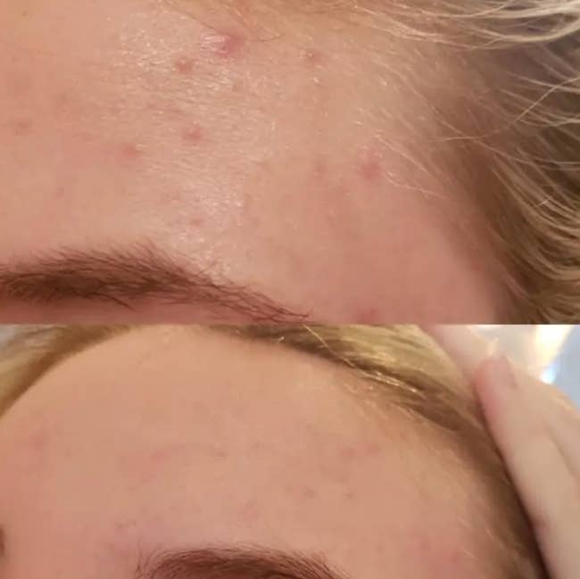 reviewer before and after photos showing their forehead acne cleared up after using the acne patches