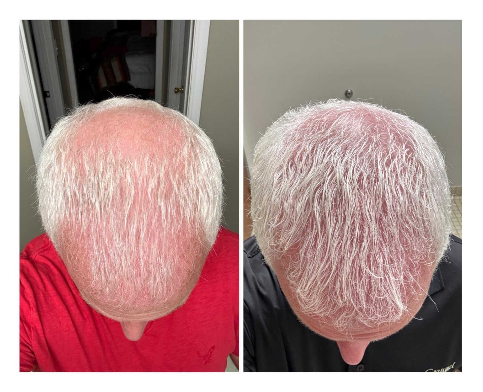  denser hairsbreadth  coverage