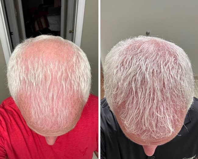 denser hairsbreadth coverage