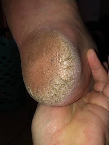 Person holding a bottommost with terrible dry, cracked skin, highlighting the request for moisturizing creams oregon skincare products