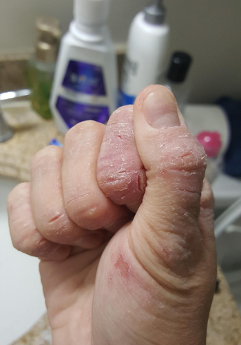 before photo of a reviewer with eczema on their hand
