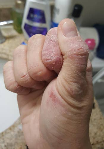 special products problem solving before photo of a reviewer with eczema on their hand
