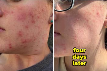 before and after of acne relieved by the cream after four days 