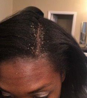 reviewer with hair parted showing extreme dandruff near scalp 