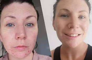 a reviewer before with breakouts and after with much clearer skin