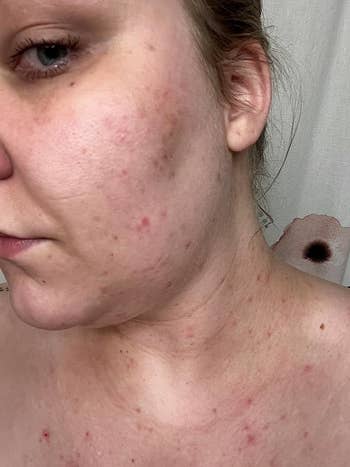 before image of reviewer with acne and redness on face and chest
