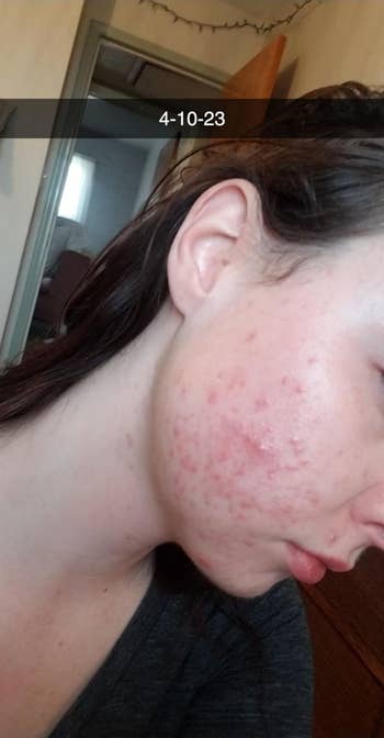 reviewer's skin with acne scars and hyperpigmentation before using serum