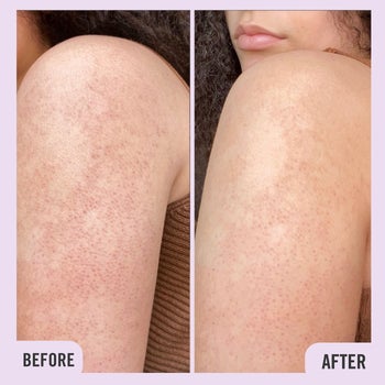 before and after of a user's arm showing minimized bumps and redness