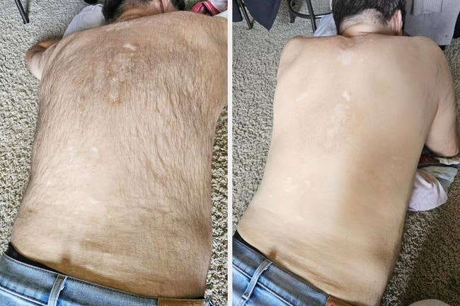 Before and aft  examination  of hairsbreadth  removal connected  a reviewer's back