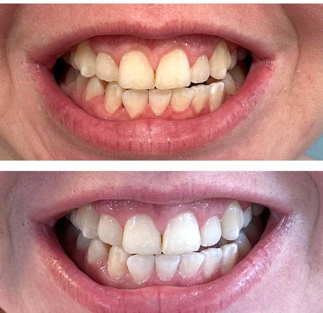 Before and after photos of teeth, showcasing the results of a whitening pen