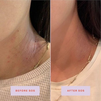 A before/after showing reduced irritation after using the spray