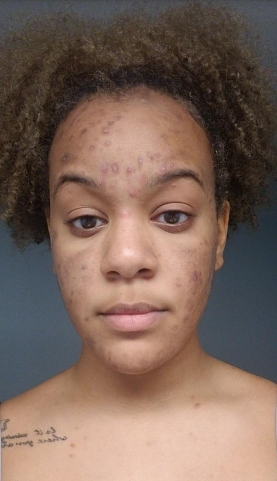 a reviewer selfie of their face dotted with acne and acne scars