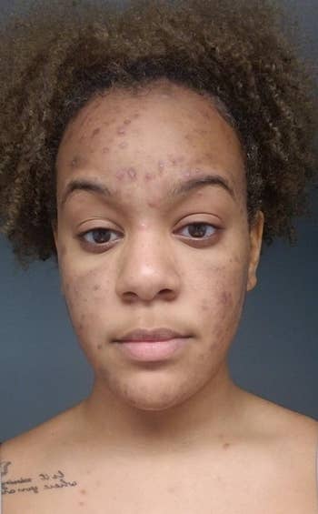 a reviewer selfie of their face dotted with acne and acne scars 