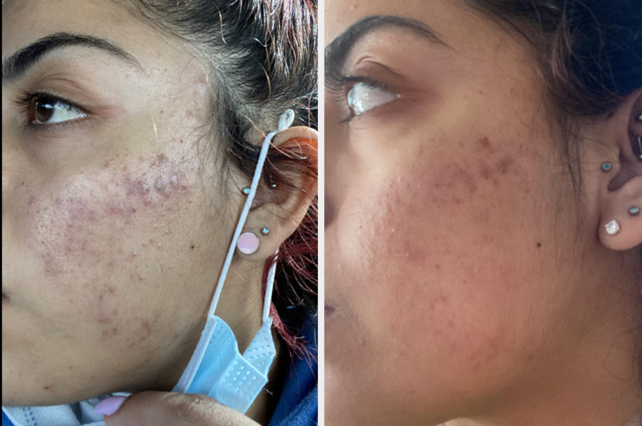 before and after of reviewer with irritated skin getting cleared up