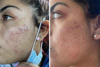 before and after image of reviewer with irritated skin getting cleared up 