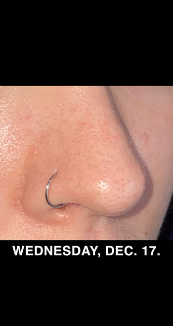 Reviewer's nose after using Paula's Choice BHA serum
