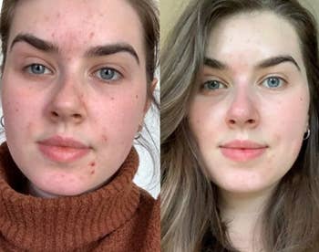 A reviewer's before and after showing reduced blemishes and a more even skin tone