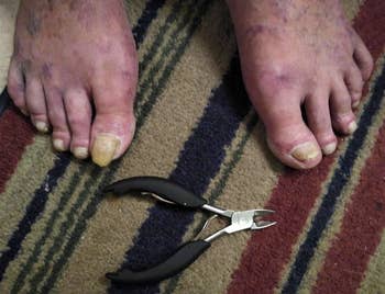 Toenails needing grooming connected a striped rug with nail clippers nearby