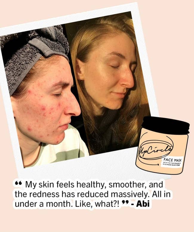 before and after images of someone with acne and redness who uses the mask and gets clearer skin; text reads 