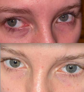 Close-up comparison of eyes showing differences in the appearance of skin under the eyes, possibly for a cosmetic product review