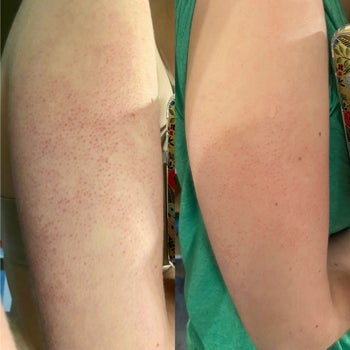 Left: reviewer's before photo of red, bumpy arm / right: arm with visibly less redness and fewer bumps