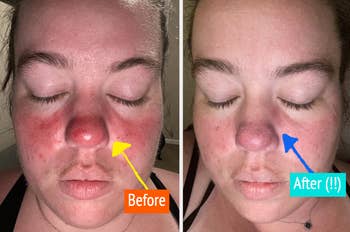 Reviewer image of before and after using calming cream