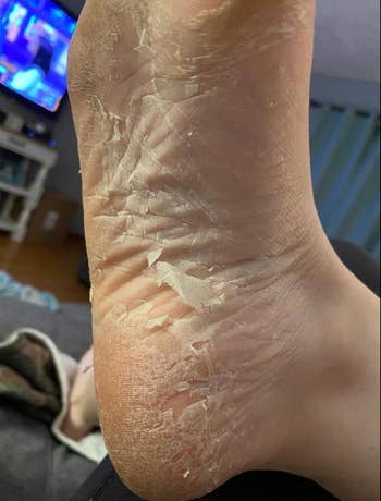Reviewer foot with peeling skin 