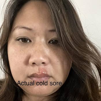 Person with a acold  sore connected  their lip, substance   reads 