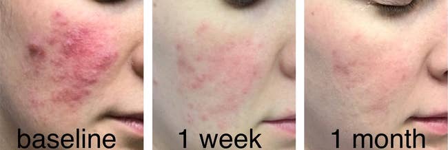 reviewer pic of extremely inflamed patch of rosacea on cheek with raised rashes, then a  lightly pink look at the same cheek a week later, then an even lighter view of the cheek a month into use