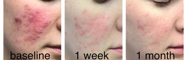reviewer pic of extremely inflamed patch of rosacea on cheek with raised rashes, then a  lightly pink look at the same cheek a week later, then an even lighter view of the cheek a month into use