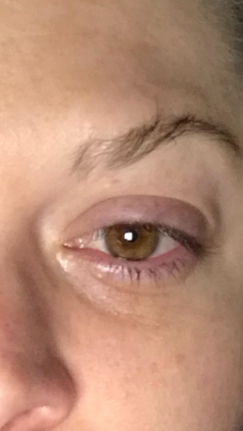 reviewer's puffy eye 