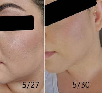 Reviewer before and after pic with smoother skin after three days 