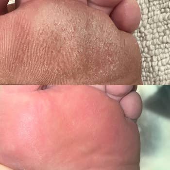 Close-up of a person's rough feet before and after using callus-removing gel