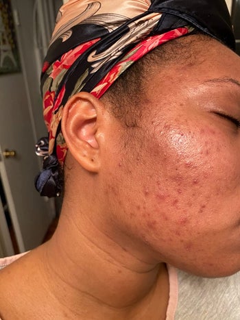 Reviewer's skin with acne before using exfoliant