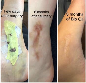 Progression of healing on a person's leg with surgery bandage, scar, and post-treatment results