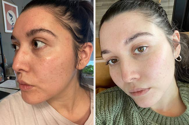 reviewer's before and after showing how much more radiant and clearer their skin looks after using the facial device for two months, once a day