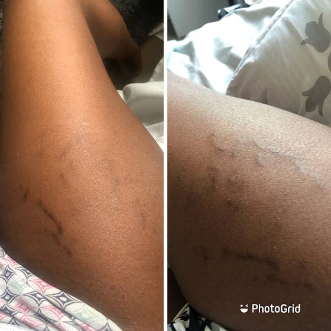 reviewer with dark skin and noticeable stretch marks on their legs that are noticeably lighter after using the cream