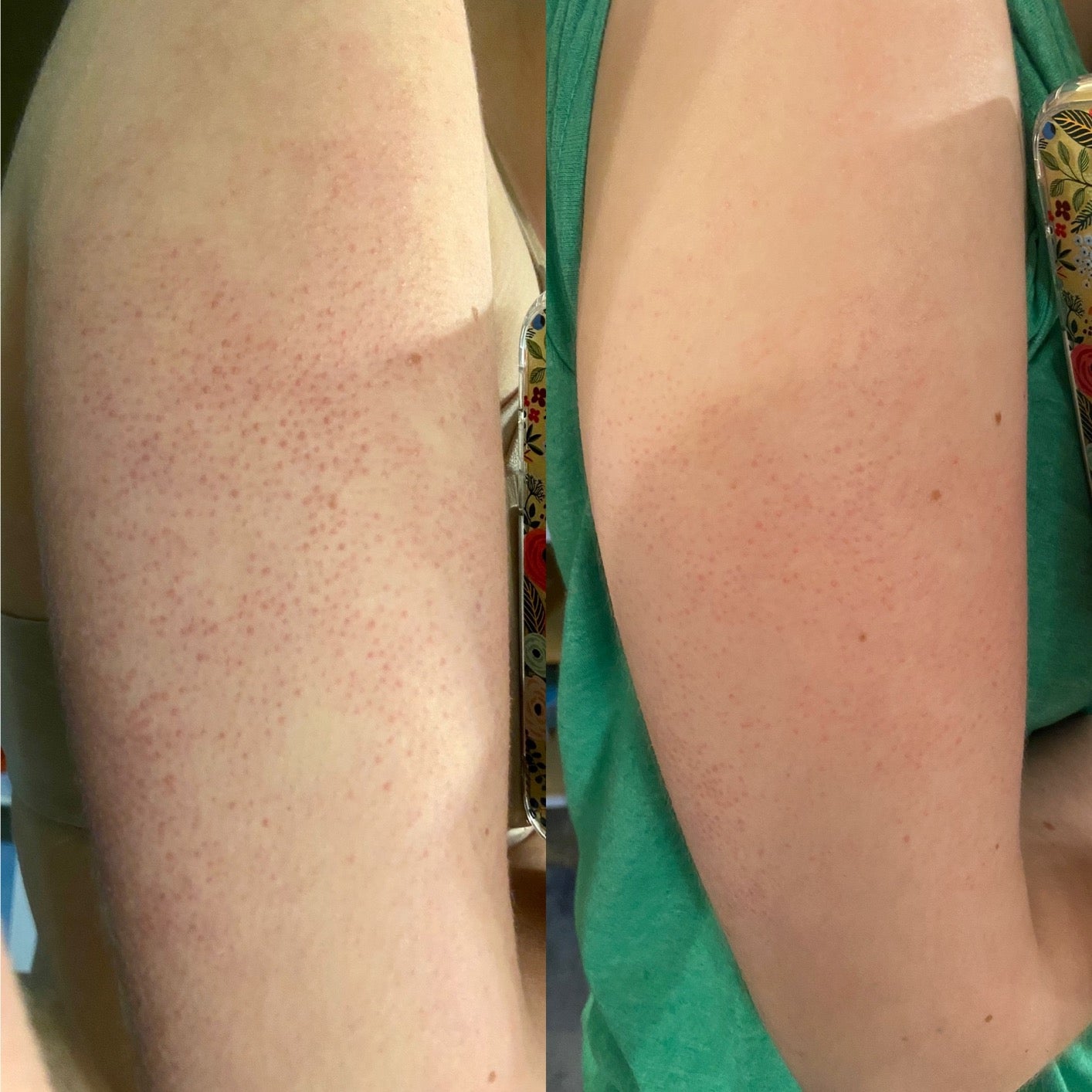 b&a photo of upper arm with small red bumps (left) and same arm with a smoother appearance (right) after using vegan body scrub