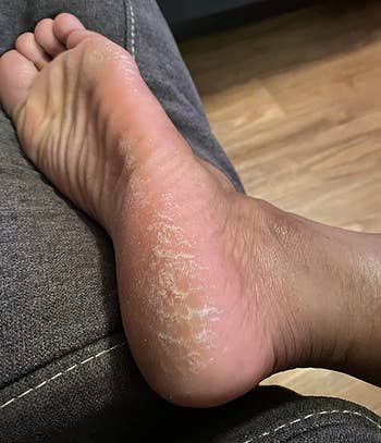 before representation of reviewer's callused foot