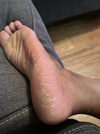 before image of reviewer's callused foot