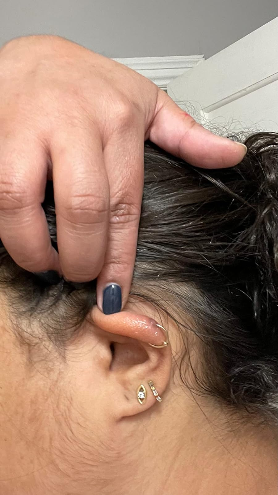 same reviewer's ear after daily use of keloid treatment